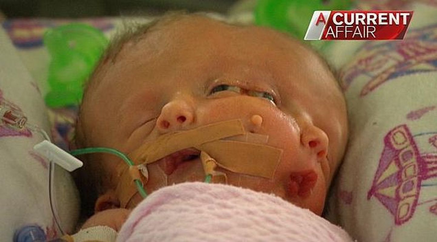 Austraalia kahe näoga laps suri