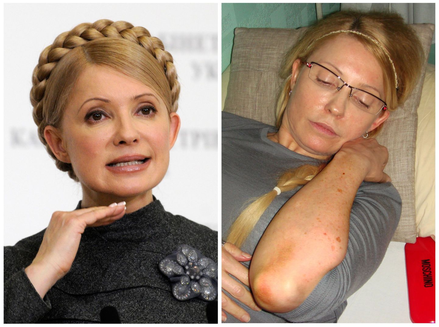 Юлия Тимошенко демонстрирует гематомы