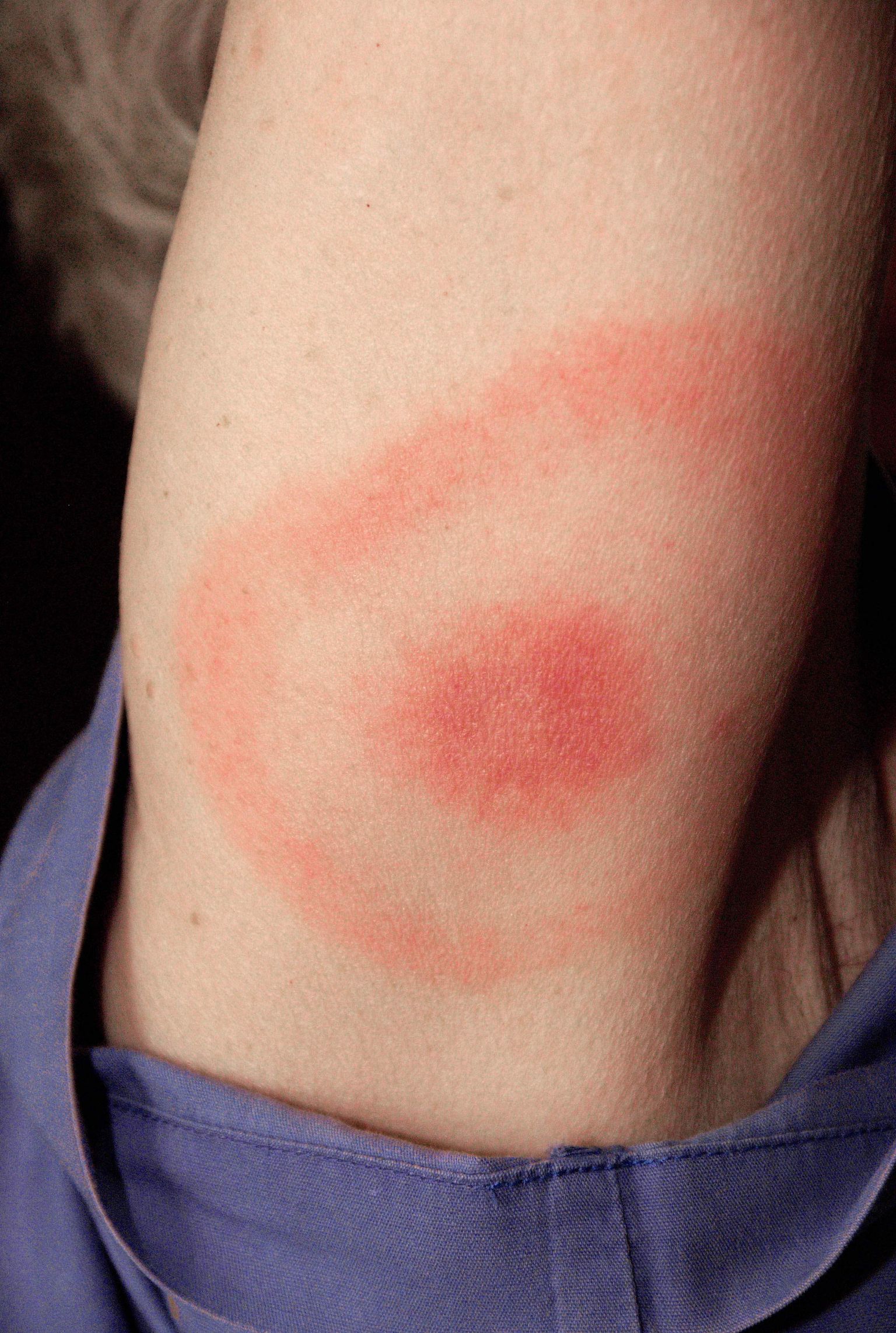 Kõige levinuma borrelioosivormi puhul tekib iseloomulik punane lööve.