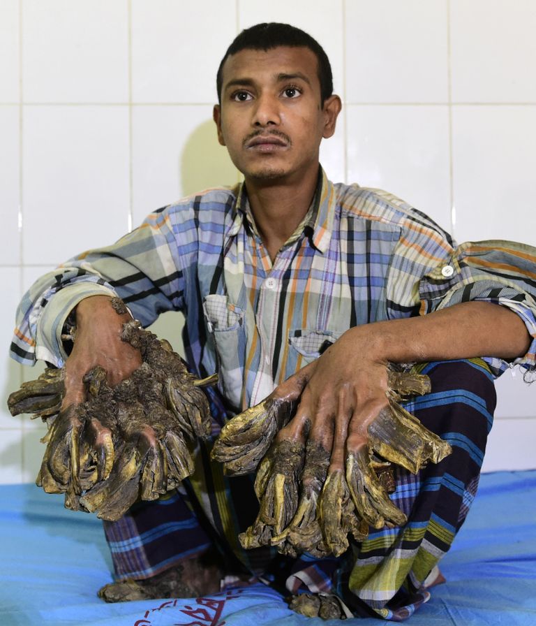 Abul Bajandar. Foto: Munir Uz Zaman/AFP/Scanpix