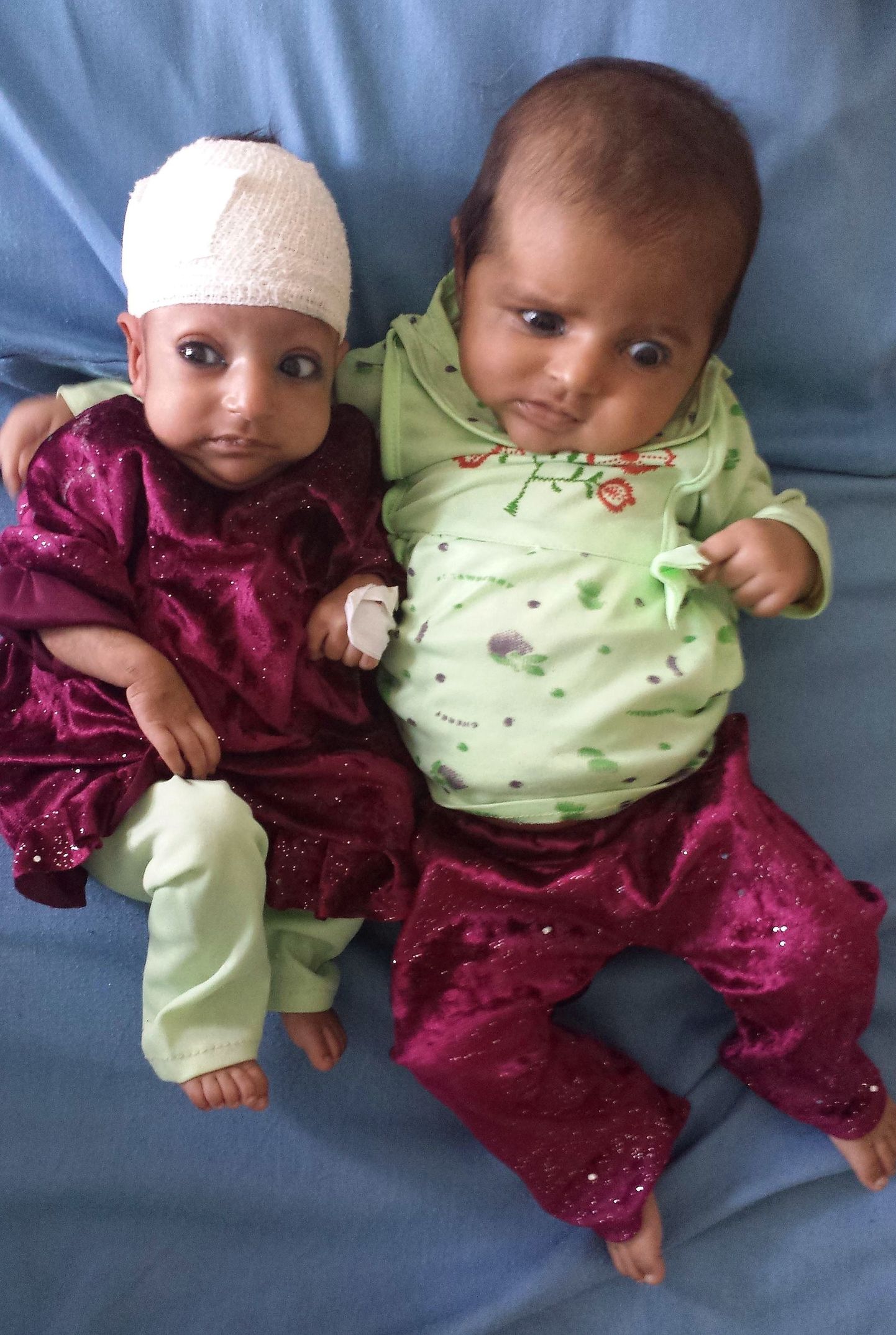 Kolmekuune Asree Gul (vasakul)pärast lisakolju eemaldamist oma kaksikõega.