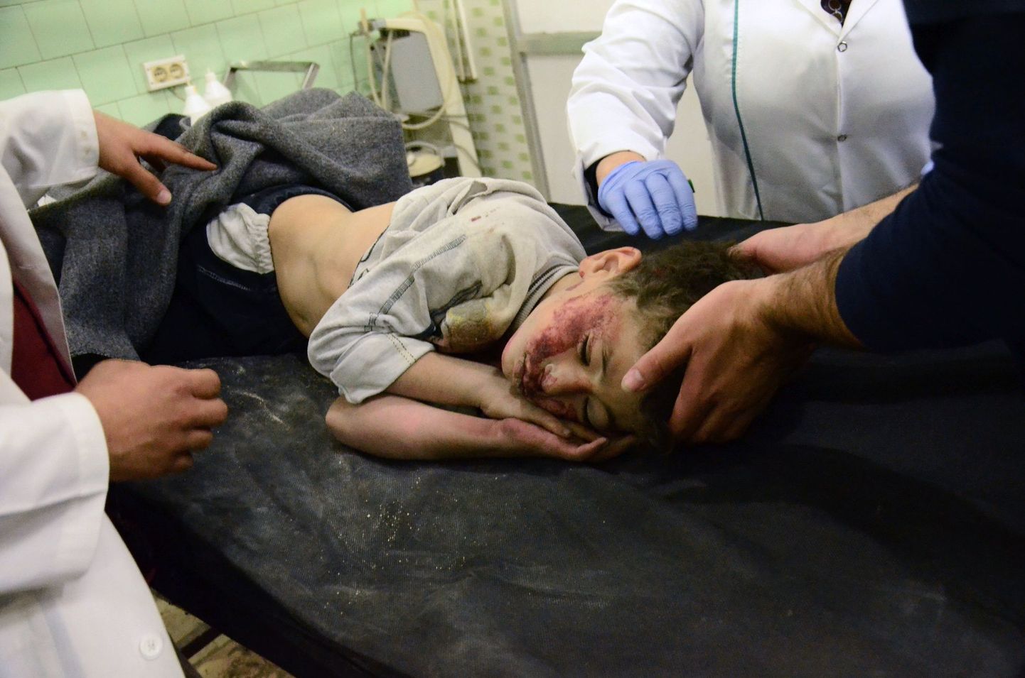 Aleppo pommitamises viga saanud väike poiss.