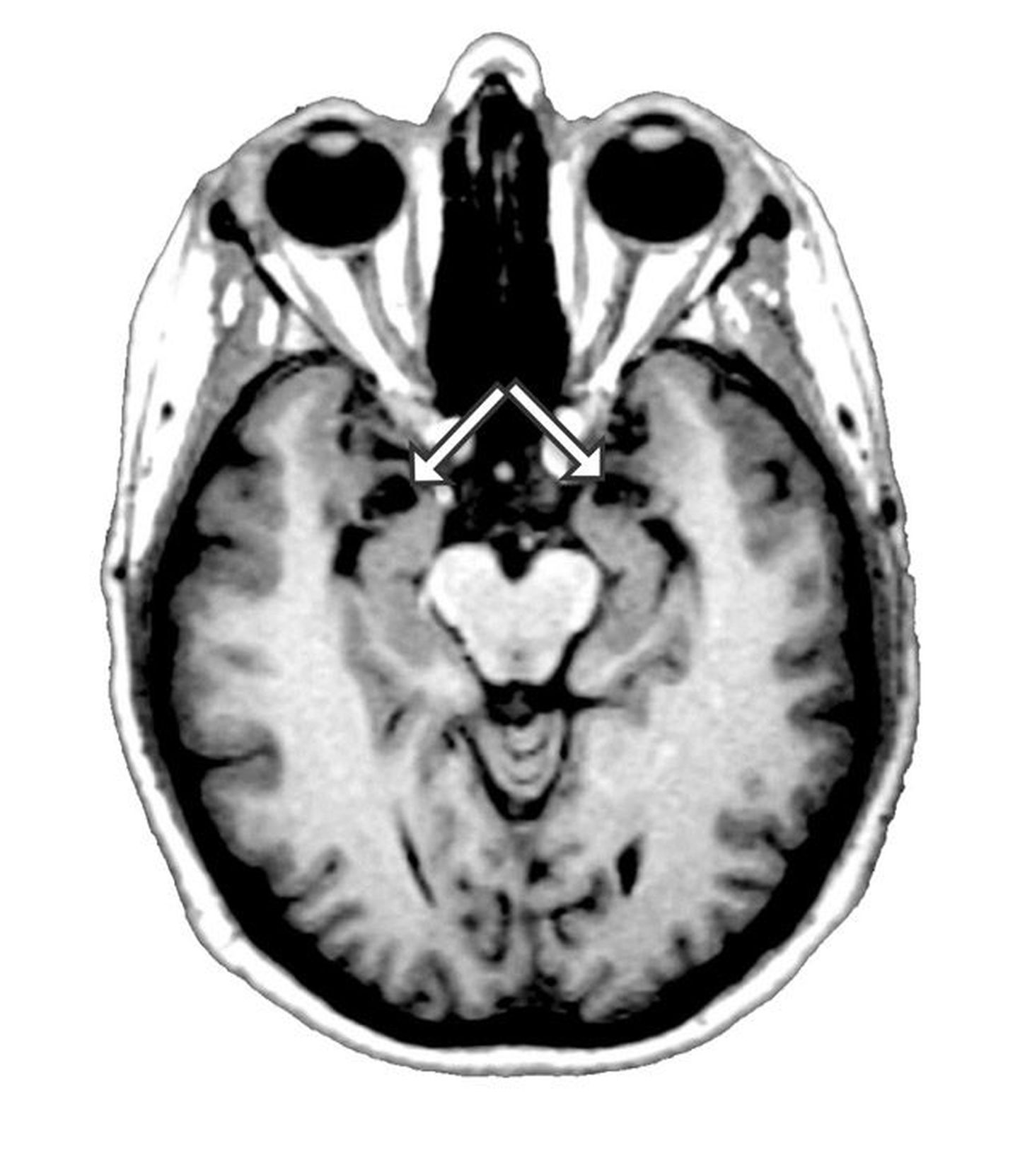 Skaneering patsiendi SM peast. Nooled näitavad, kus ta aju mandelekehas on kahjustused
