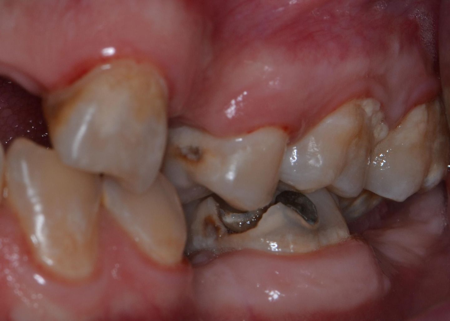 Hambaid hoiavad lagunemise eest hammastele tervislik toitumine ja korralik suuhügieen.