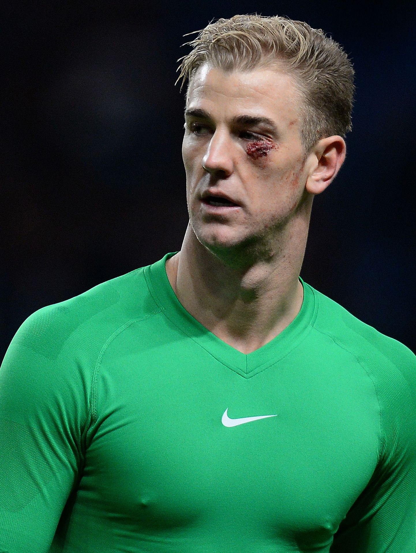 Manchester City väravavaht Joe Hart sai valusa kokkupõrke järel Crystal Palace'i ründaja Cameron Jerome'iga silma alla suure haava.
