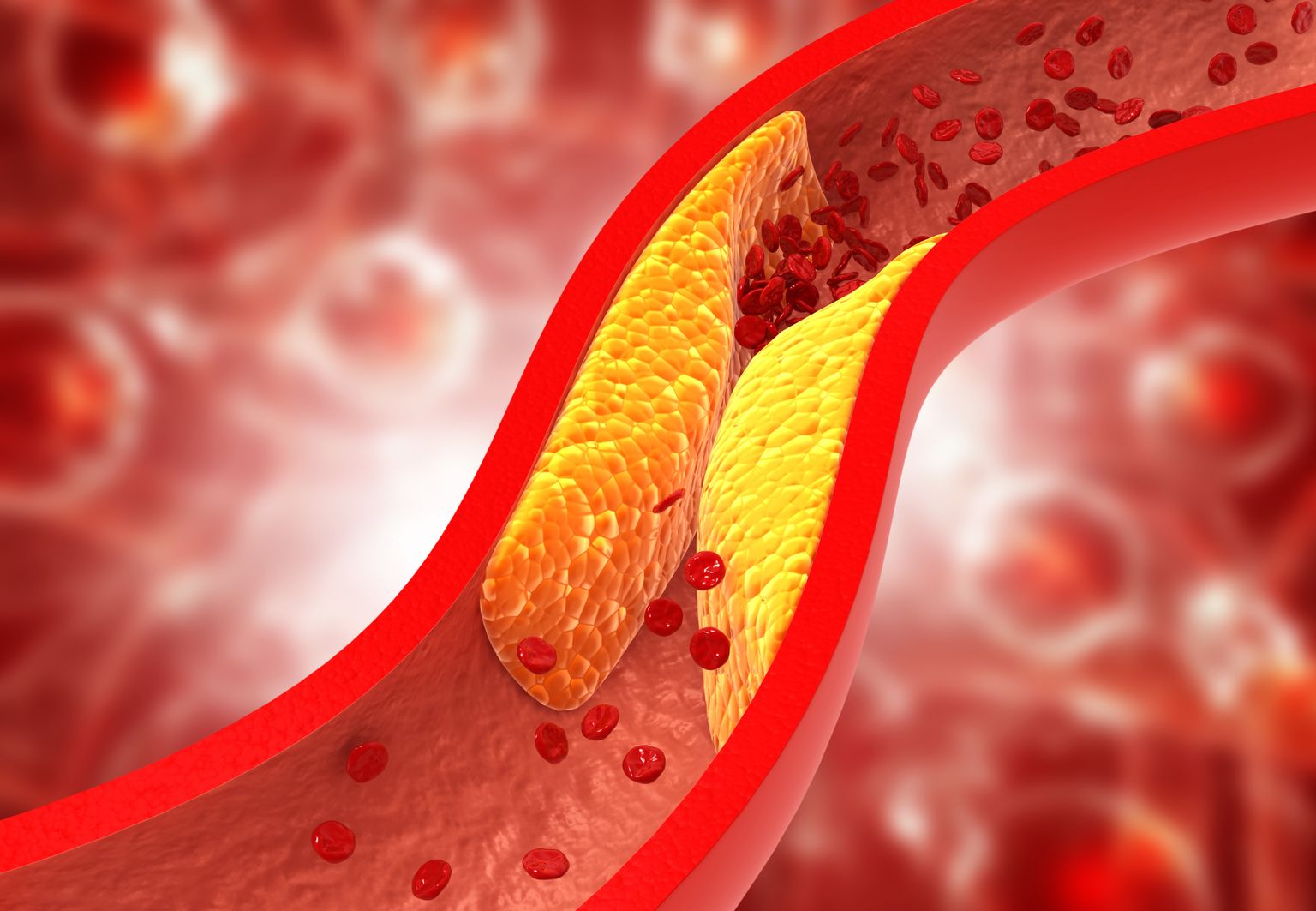 Kõrge LDL- ehk «halb» kolesterool on üks peamine südamelihase infarkti ja insuldi riskitegur.