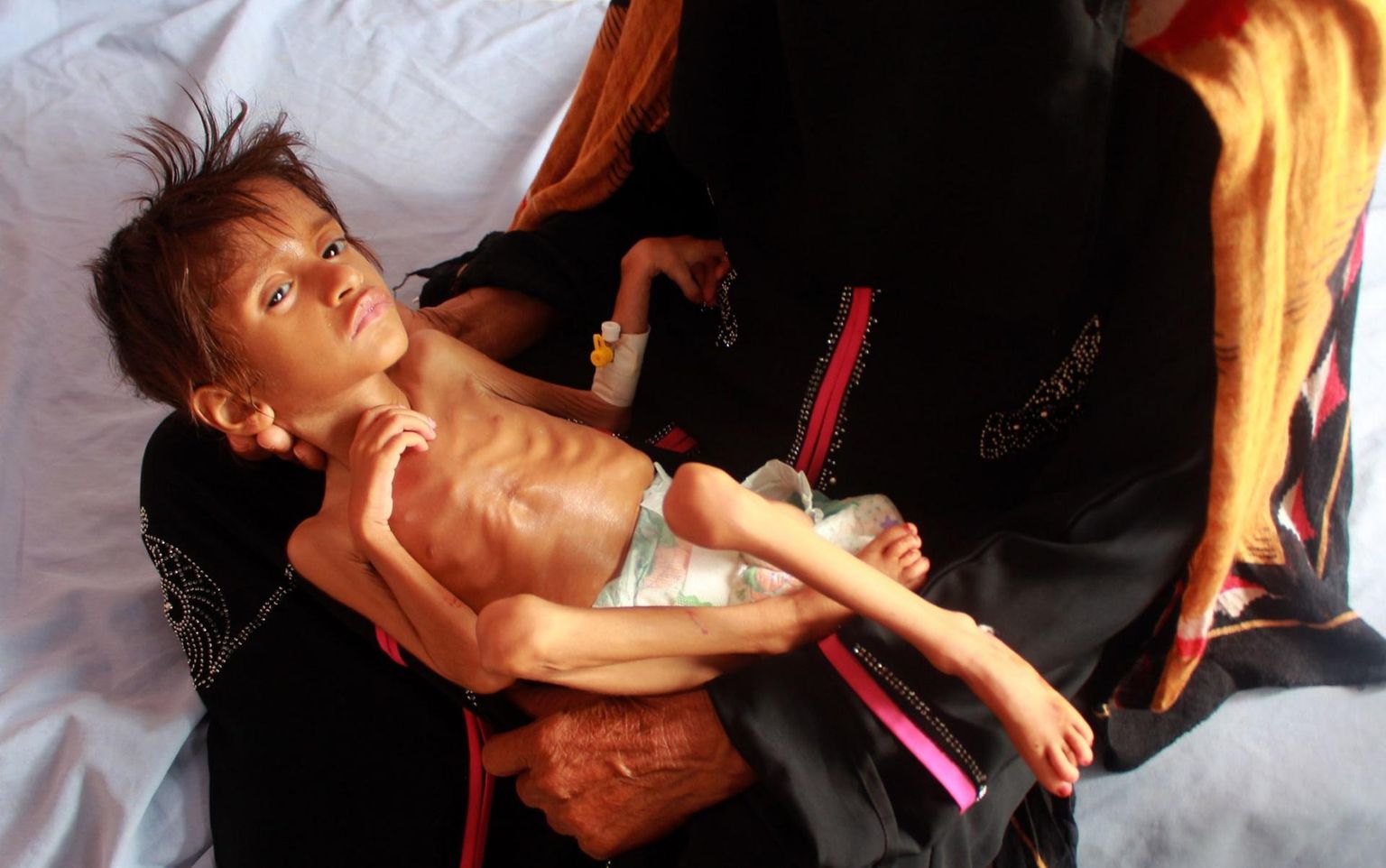 Tänavu 5. juulil Põhja-Jeemenis Hajjah’ provintsis tehtud foto alatoitumuses lapsest. ÜRO Lastefondi teatel elavad seal alatoitumuses miljonid lapsed ja tegu on praeguse maailma suurima humanitaarkriisiga. 