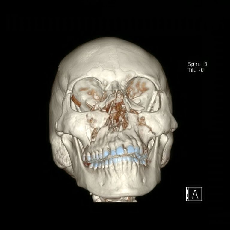 Kompuutertomograafiline uuring, kus on näha Coltoni muljutud kolju enne operatsiooni. 