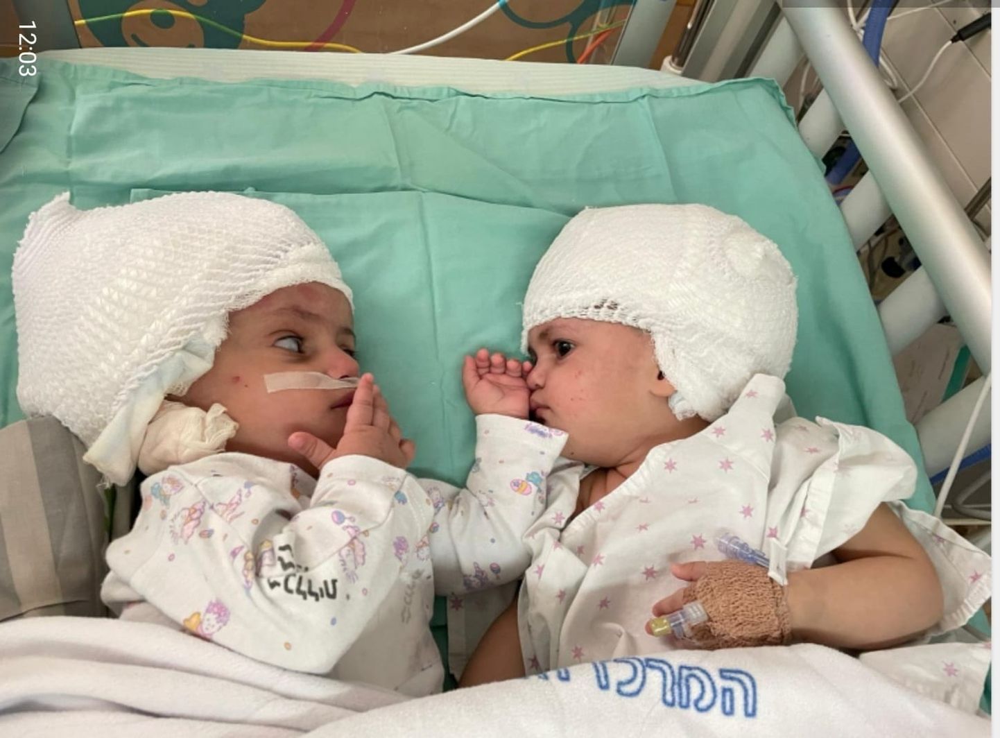 Endised siiami kaksikud näevad teineteist esimest korda, pärast seda, kui nad operatsiooni teel eraldati.