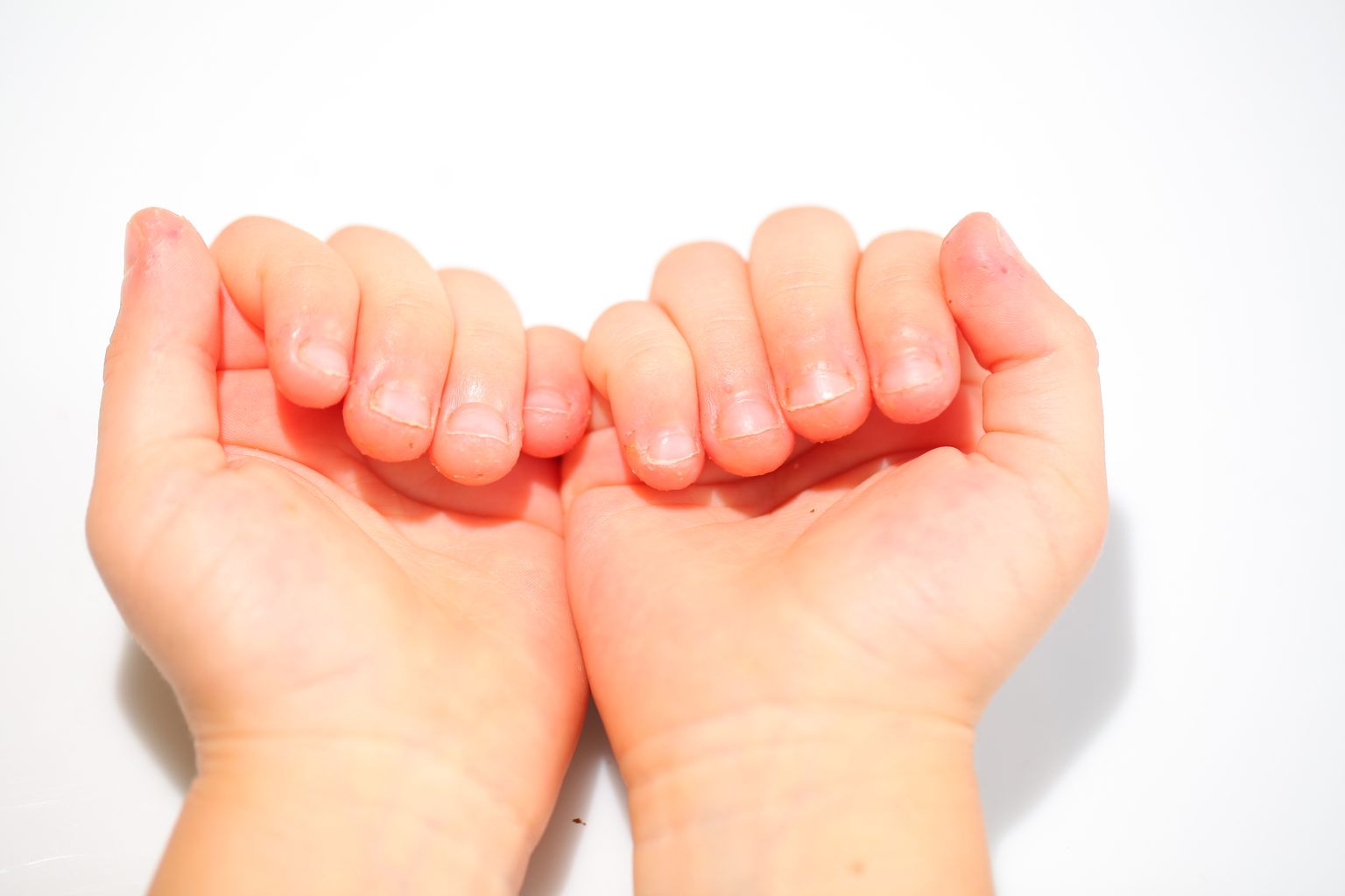 Küünte närimise esmaseks ohuks on, et käed, küüned ja küünealused pole tavaliselt puhtad.