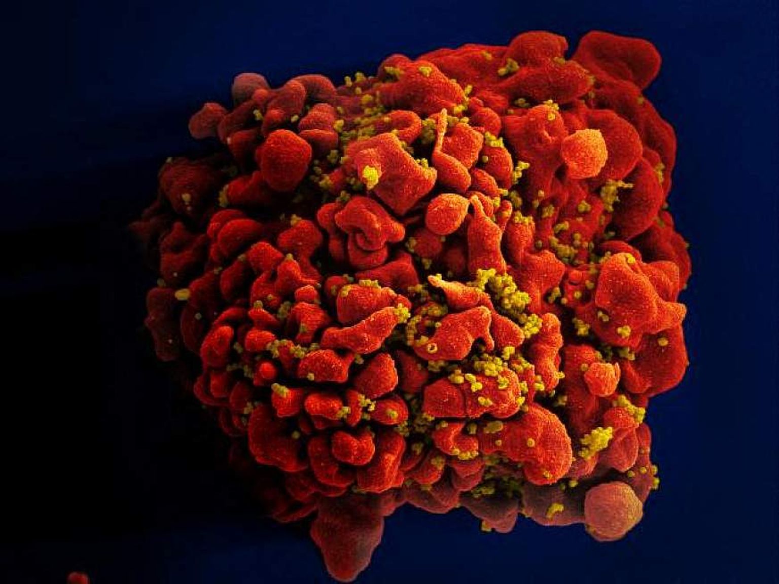 HIV-viirusega nakatunud inimese valged verelibled. Pilt on illustreeriv.