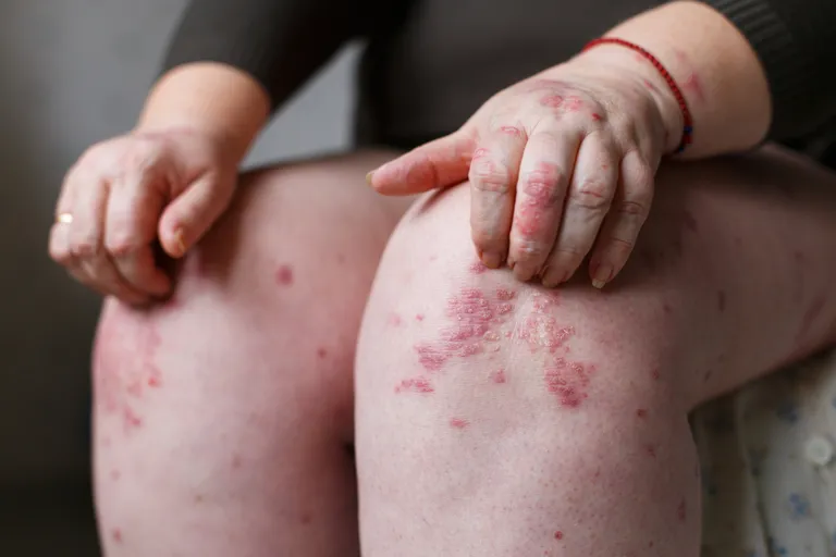 Psoriaasihaige.