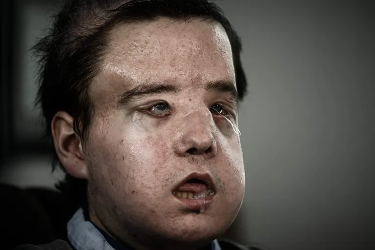 Jérôme Hamonile tehti kaks näosiirdamist