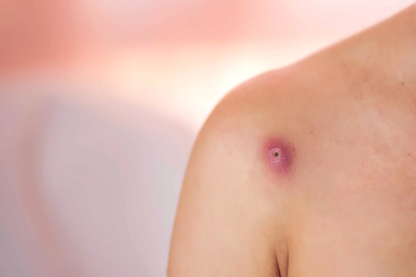 Ebameeldivad mädapaised ehk furunkulid: miks tekivad ja kuidas ravida?