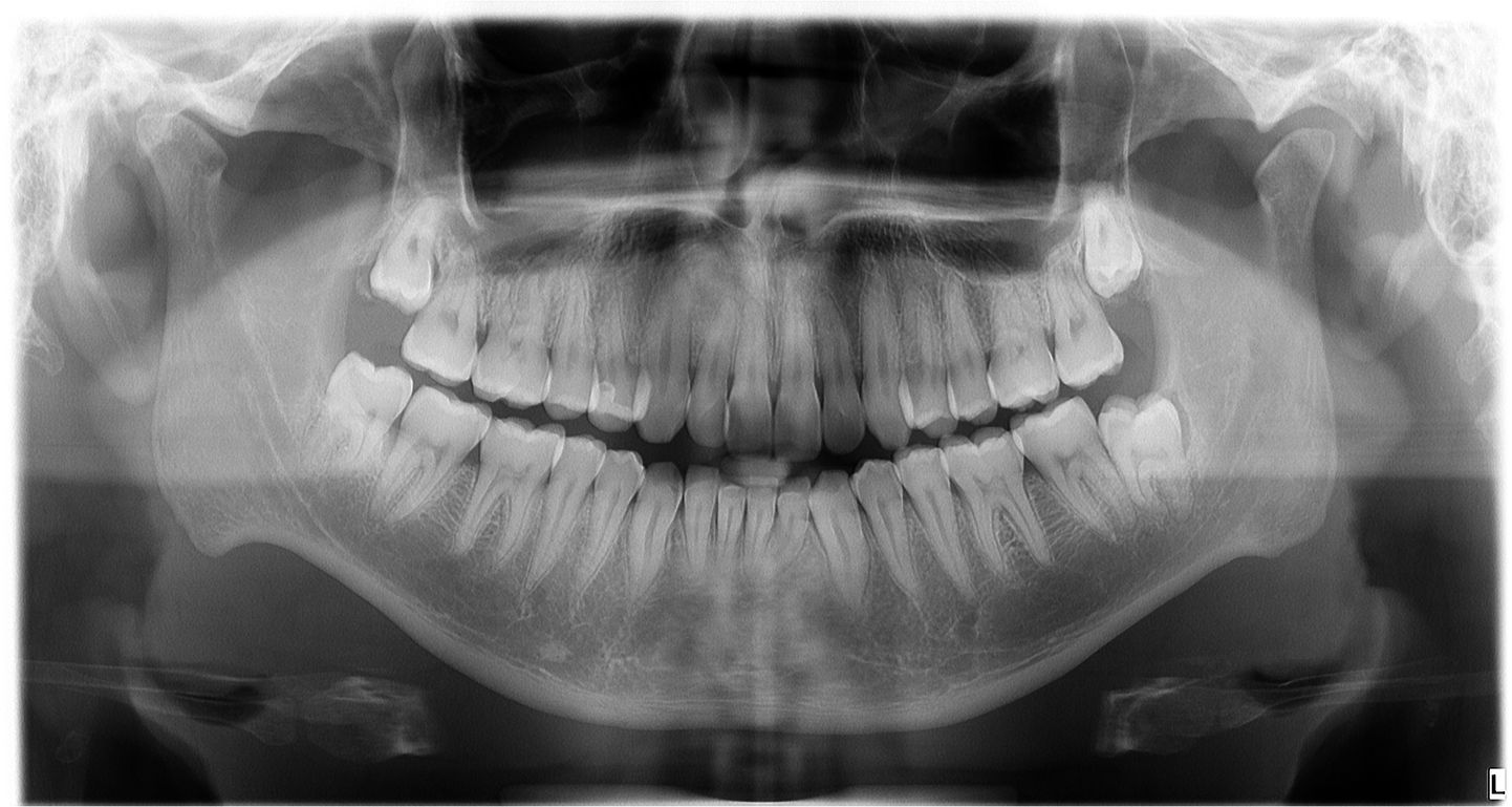 Röntgenülesvõte hammastest.