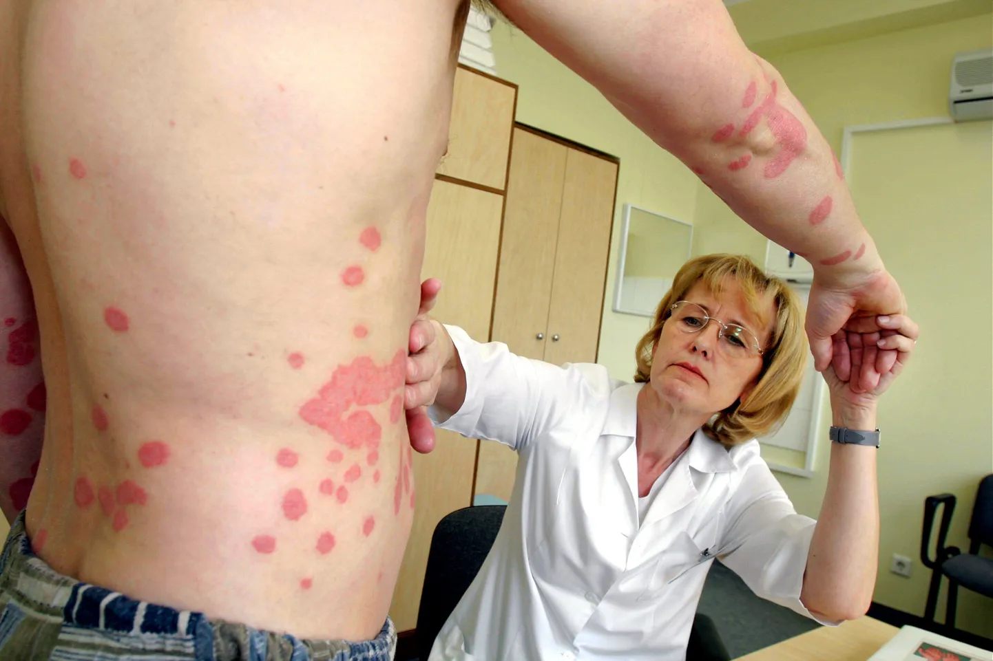 Nahaarst Sirje Kaur uurimas psoriaasiahiget.