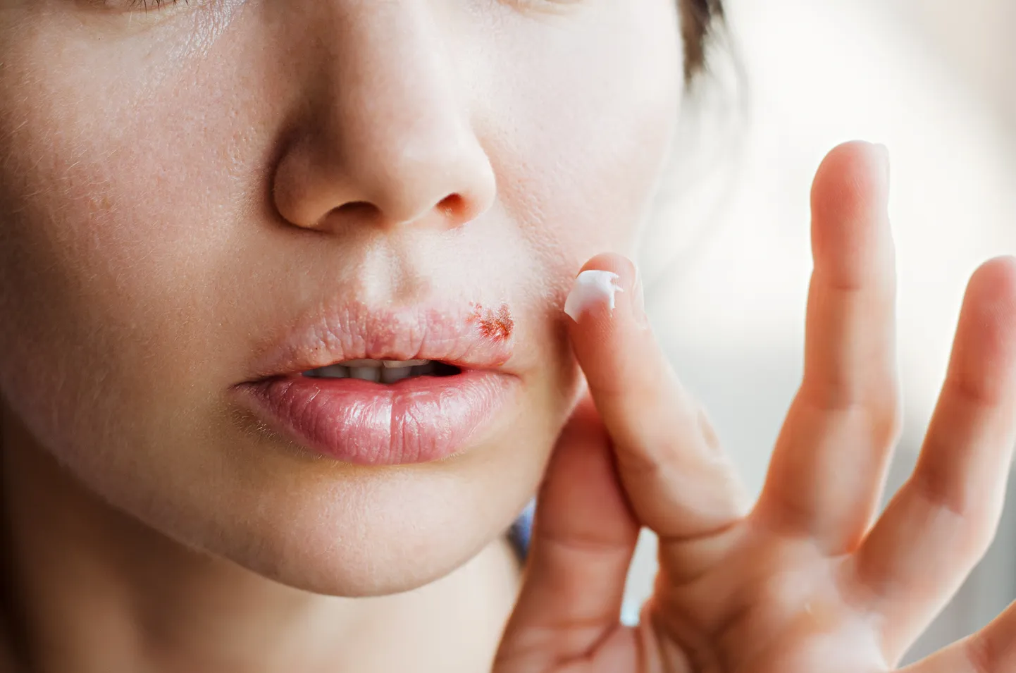 Huuleherpes.