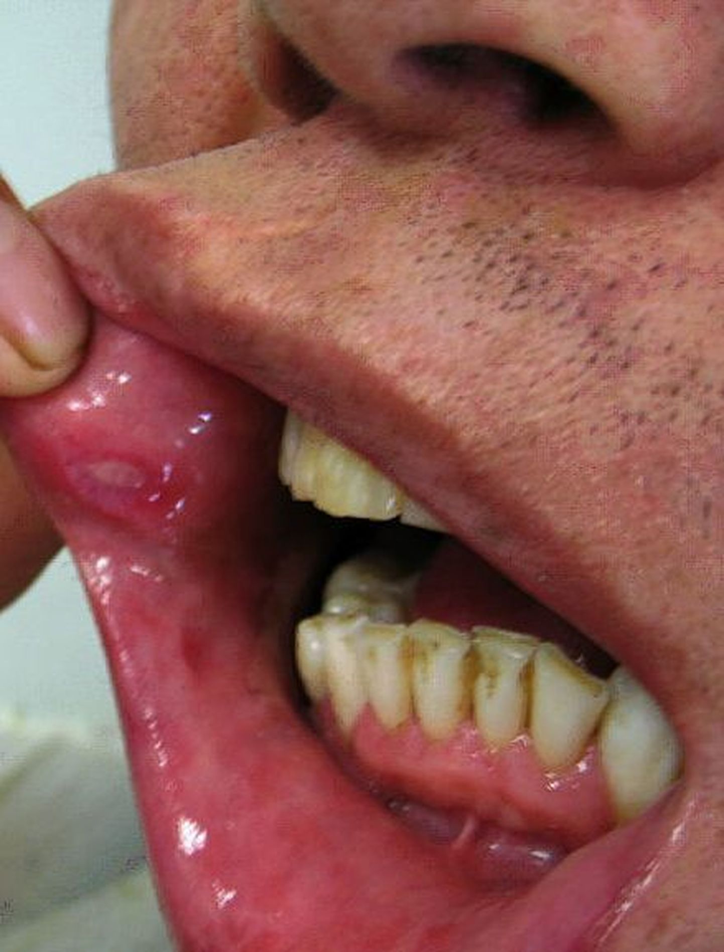 Becheti tõve puhul on haavandid suus ja genitaalidel