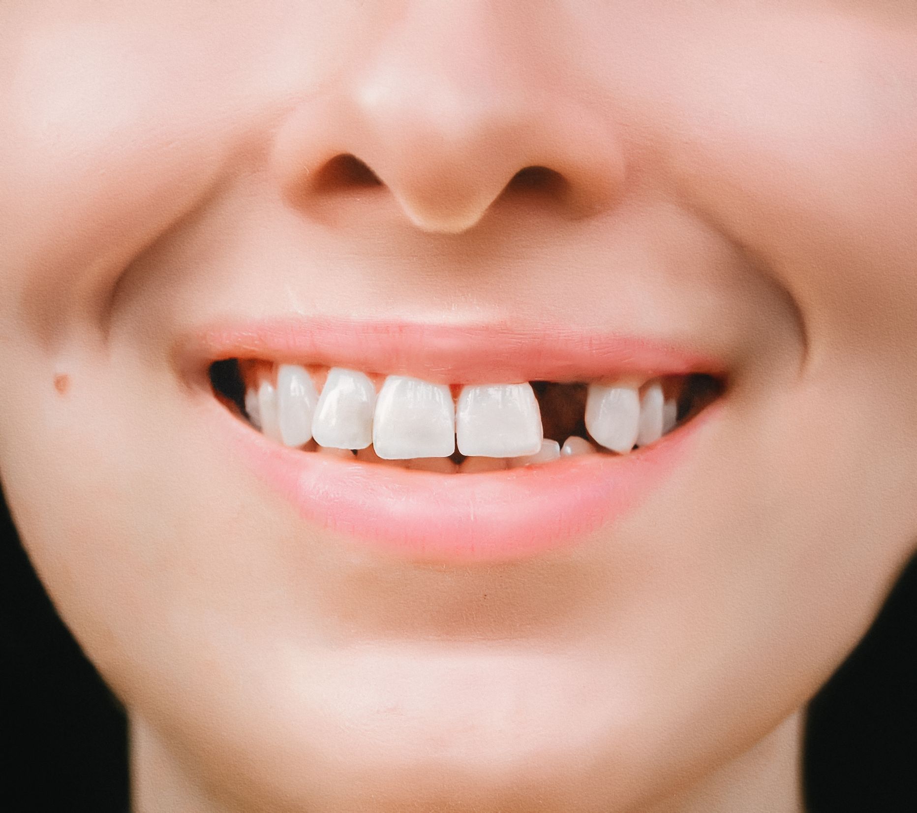Suutervise uuring näitab, et inimestel vanuses 35-44 on keskmiselt pooled suus olevatest hammastest terved ning 75-aastastel ja vanematel on kaotatud kaks kolmandikku hammastest