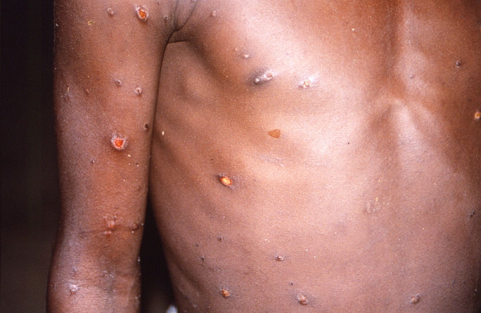 Ahvirõugete lööve. Foto on tehtud Kongo Demokraatlikus Vabariigis, kus oli selle haiguse puhang 1996–1997