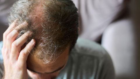 Teadlased on välja töötanud paljulubava ravi alopeetsiaga võitlemiseks