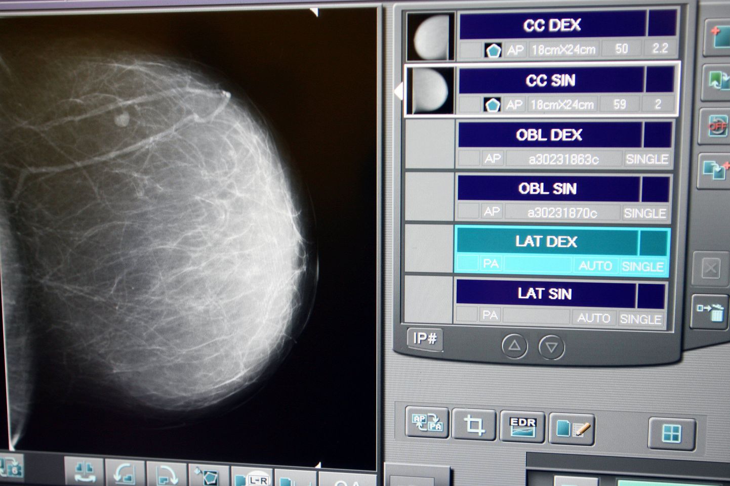Rinnavähi kahtluse korral saadetakse patsient ultrahelisse või mammograafiasse.