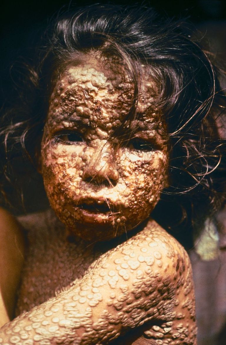 Ar bakām slims bērns Bangladešā.