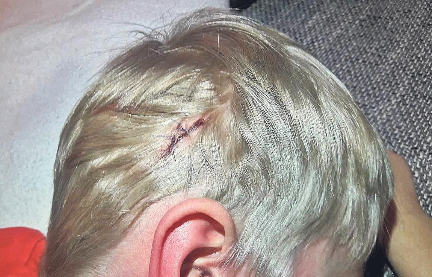 Kukkudes sai Eduard Noormägi viieaastane poeg pähe parema kõrva juurde mitme sentimeetri pikkuse haava, mille õmblemiseks ei tehtud poisile tuimastavat süsti.