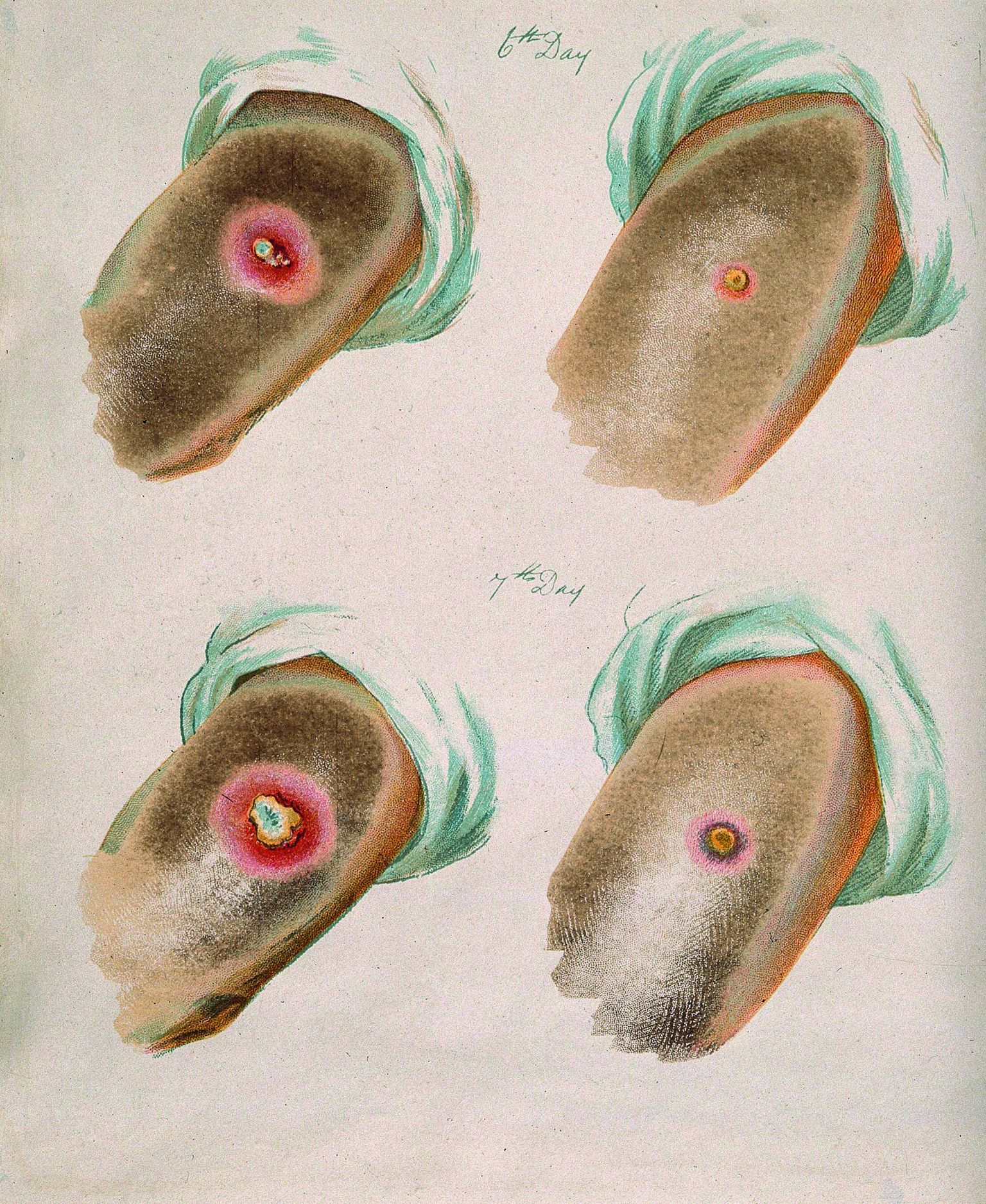 Rõugete (vasakul) ja veiserõugete villid 6. ja 7. päeval pärast haigestumist (G. Kirtland, 1896). Veiserõuged kulgevad inimesel väga kergelt.
