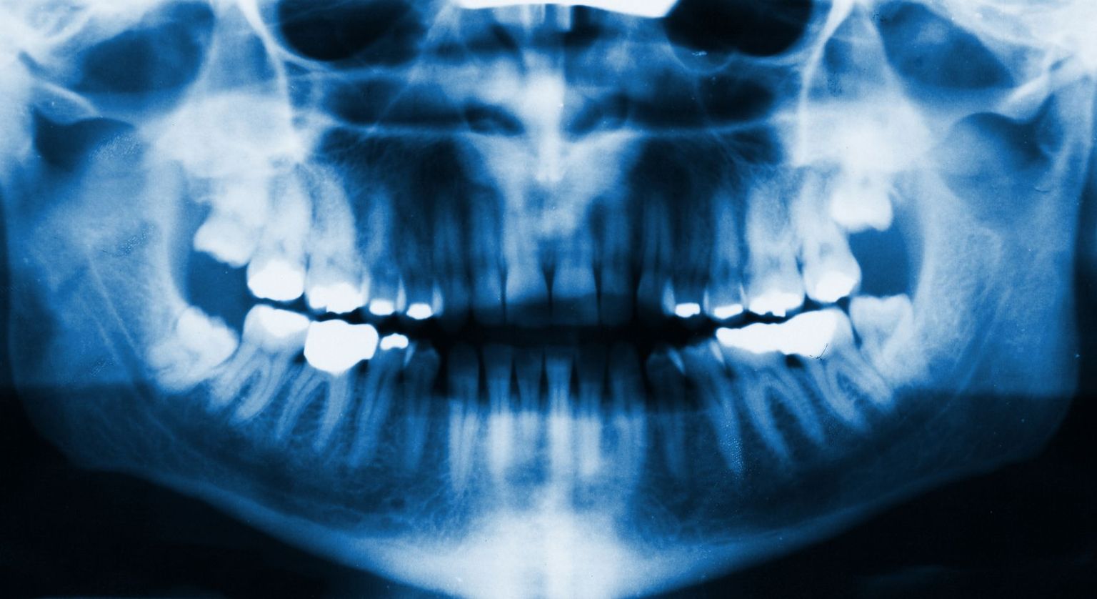 Mõned inimesed on asunud mürgitusehirmus hammastest elavhõbedaplomme välja tõmbama.