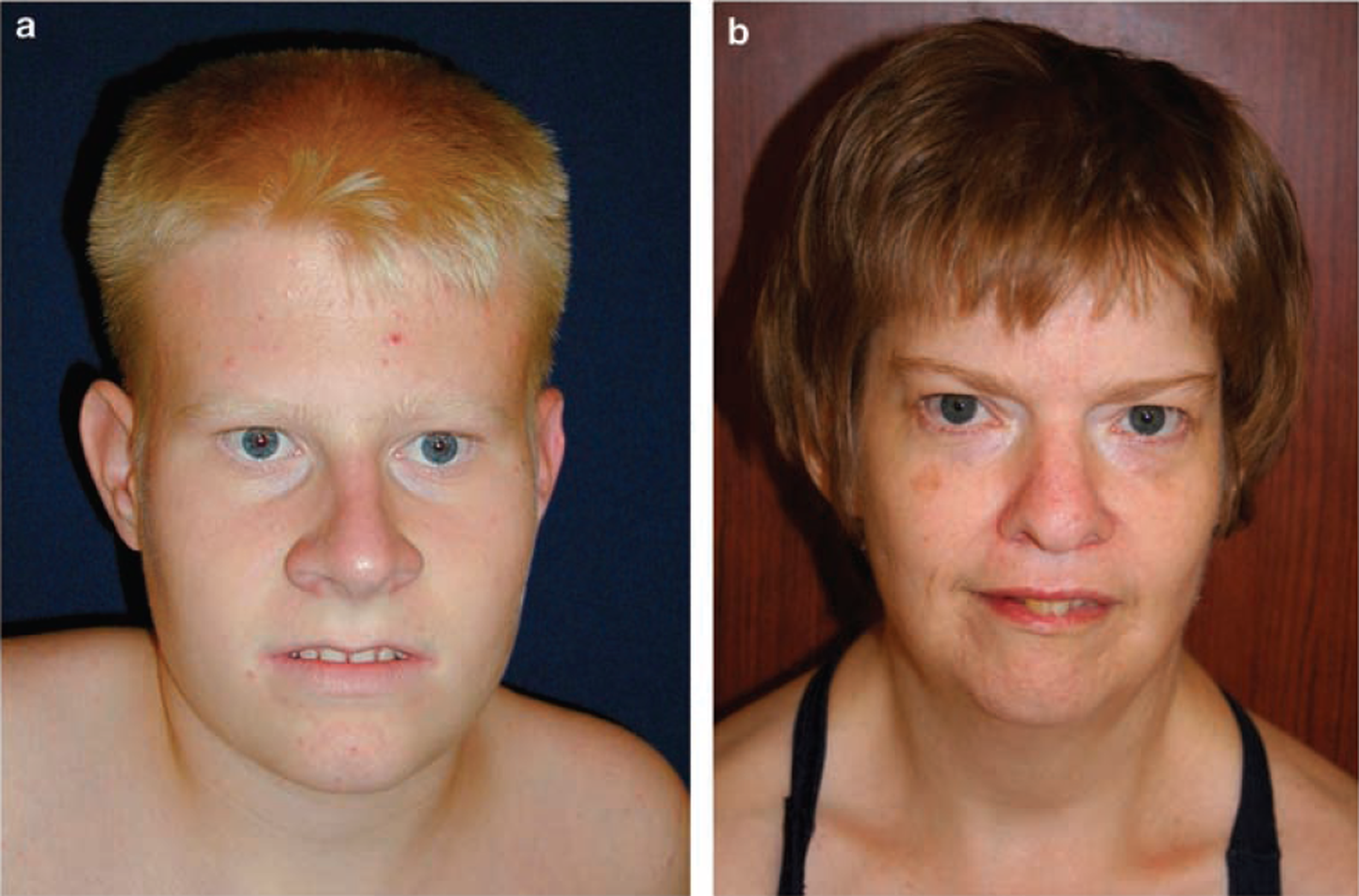Prader-Willi sündroom väljendub ka iseloomulikes näojoontes.