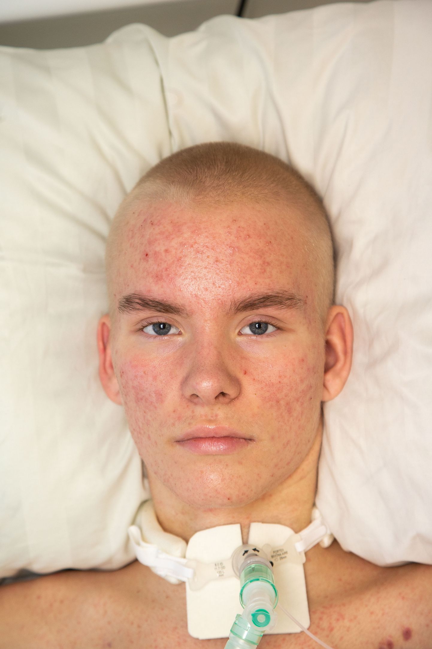 18.12.2018. Maailmameister eneseületuses. Pärast suvel toimunud õnnetut vettekukkumist on 15aastane Rasmus kaelast allapoole halvatud ning aheldatud voodisse, sõltudes täielikult hingamisaparaadist ja perekonna hoolitsusest.