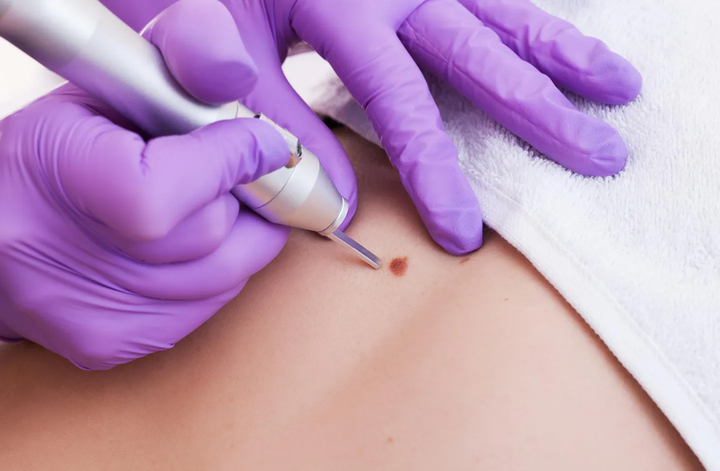 Kui tohtril jääb ülevaatusel kahtlus pahaloomulisusele või on dermatoskoobiga raske täpset diagnoosi panna, siis sünnimärk eemaldatakse.