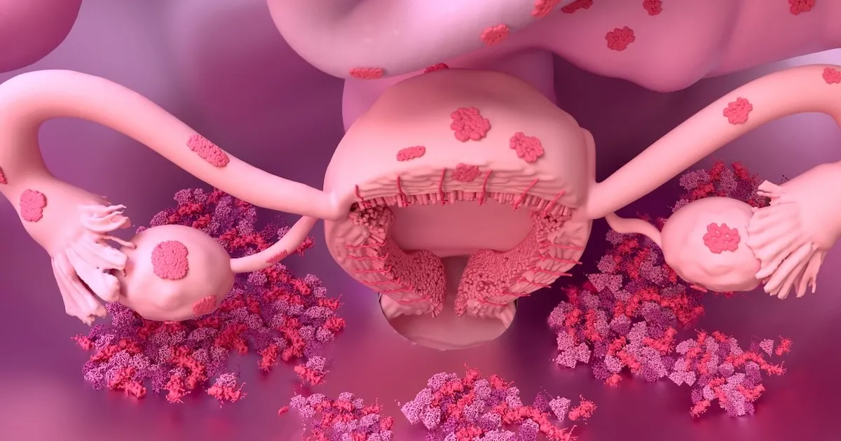 Endometrioosi ravim sai tervisekassa soodustuse