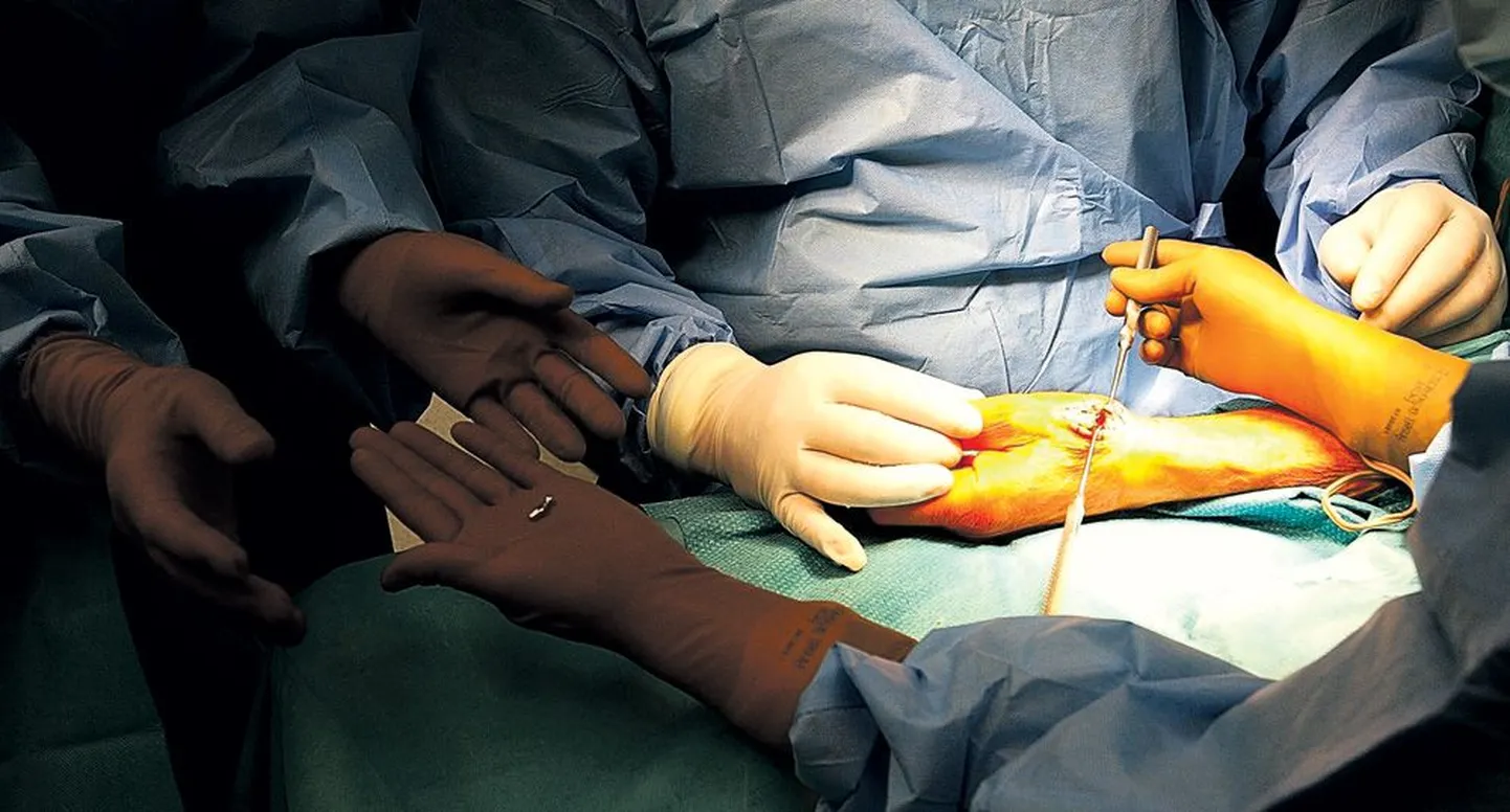 Pöidlaliigese proteesimise operatsioon. Pilt on illustratiivne.