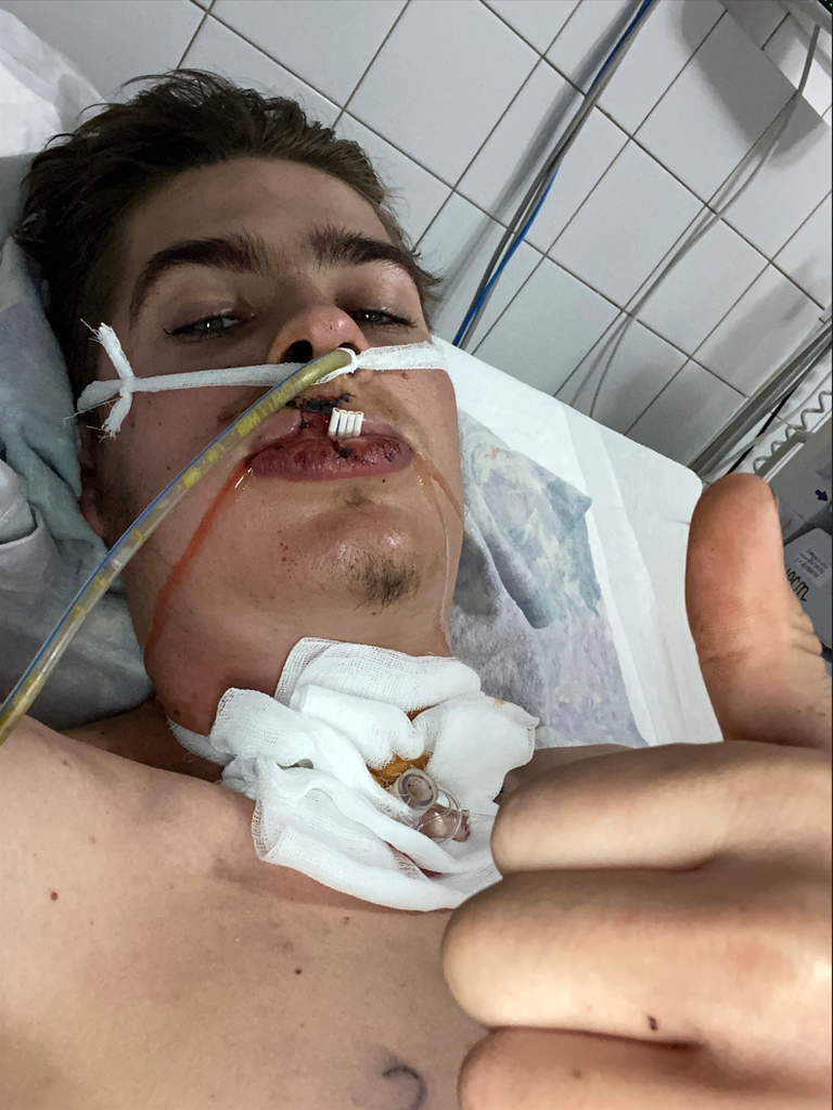 Чтобы спасти Ивана (на этом снимке он восстанавливается в больнице), брат прорезал ему в горле отверстие, чтобы он мог дышать