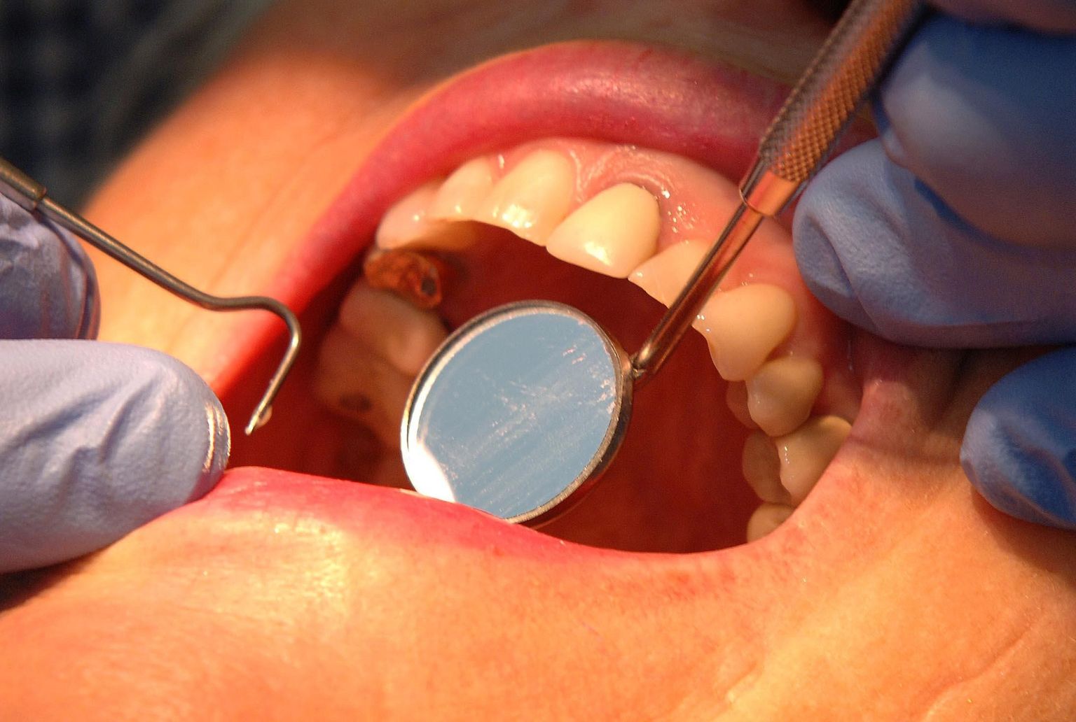 Tervise-ja tööminister lubab, et täiskasvanute hambaravi hakatakse järgmisel aastal taas hüvitama.