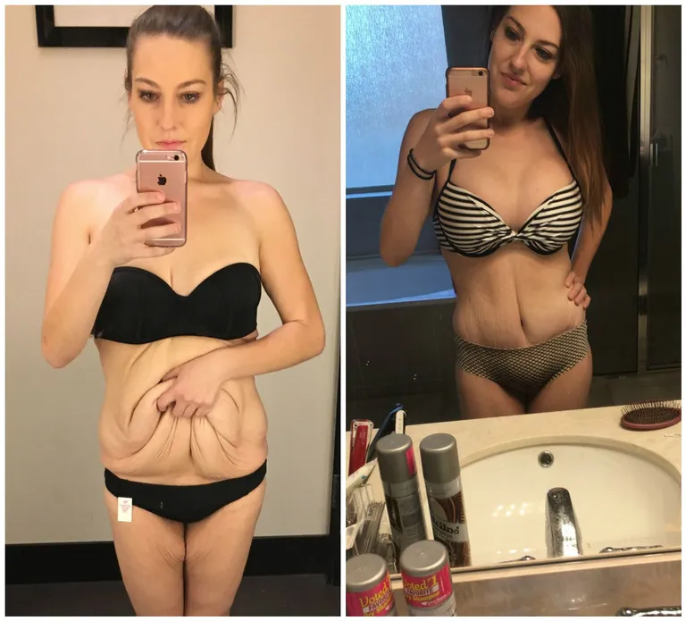 Lyndsey Hoover enne ja pärast iluoperatsioone.