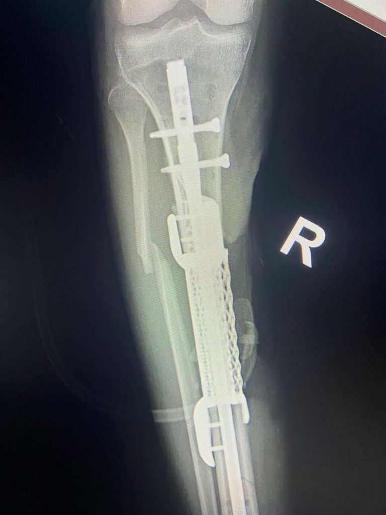 Рентген-снимок с изделием, соединяющем кость. В последствии костные ткани прорастут в изделие, и произойдет сращивание тканей в цельную кость. 