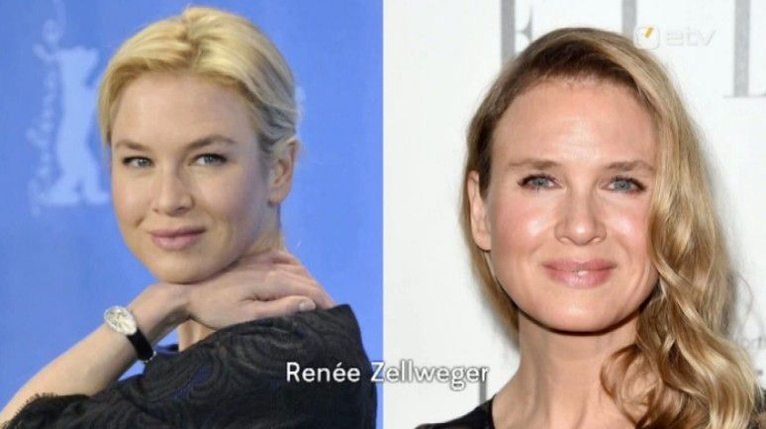 Renee Zellweger enne ja pärast