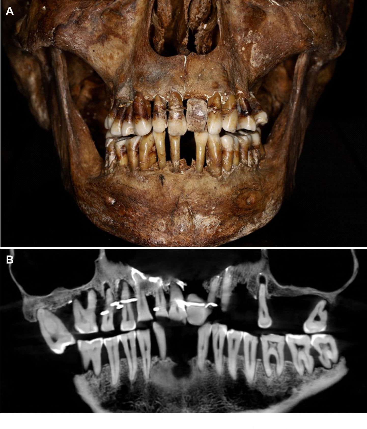 Prantsuse 16.–17. sajandi aadlidaami Anne d'Alegre hammaste skaneering näitas, et ta põdes parodontiiti ning ta kasutas hammaste kinnitamiseks kuldtraati