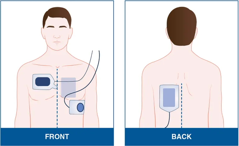 Tumesinised defibrillatsioonipadjad näitavad padjandi asetust eesmises-lateraalses asendis. Helesinised defibrillatsioonipadjad näitavad padja paigutust eesmises-tagumises asendis.
