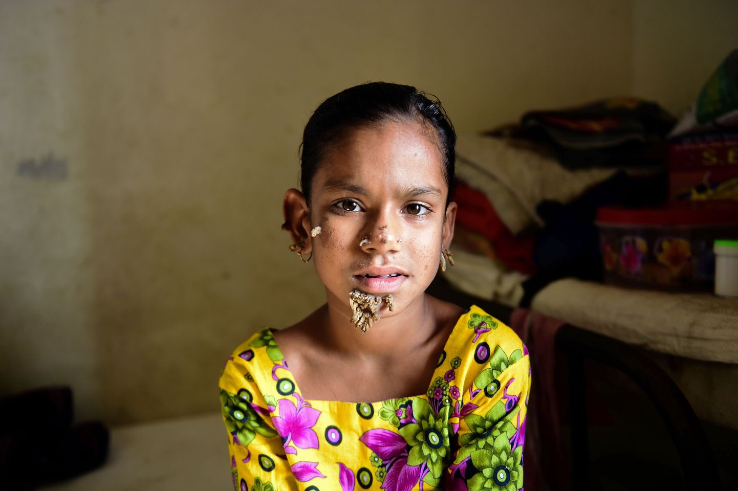 10-aastane Sahana Khatun otsis abi Dhaka arstidelt.