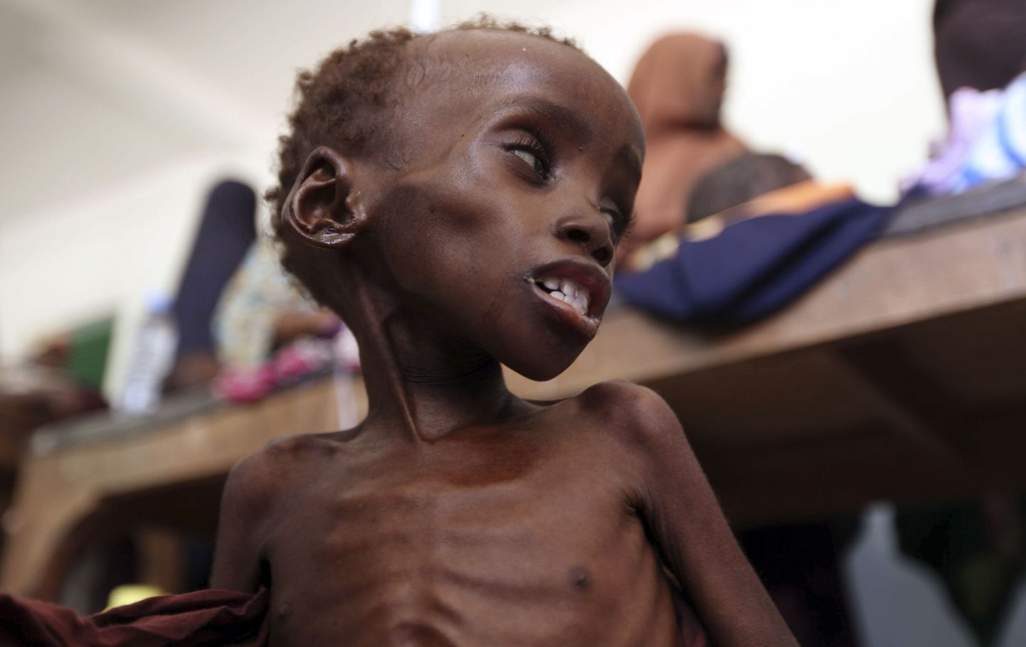 Alatoidetud laps üleeile Somaalia pealinna Mogadishu haiglas.