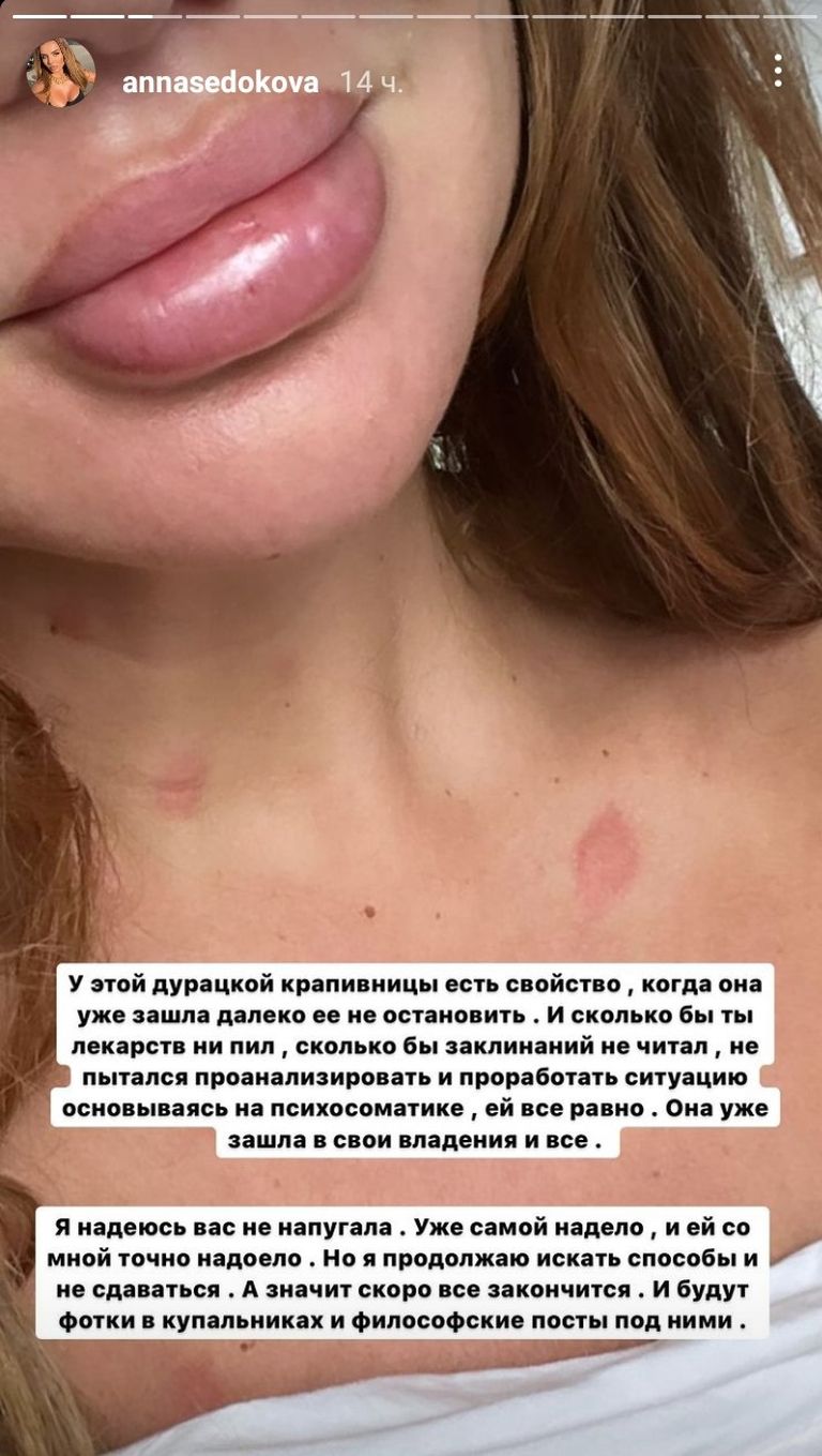 Анна Седокова во время обострения хронической крапивницы