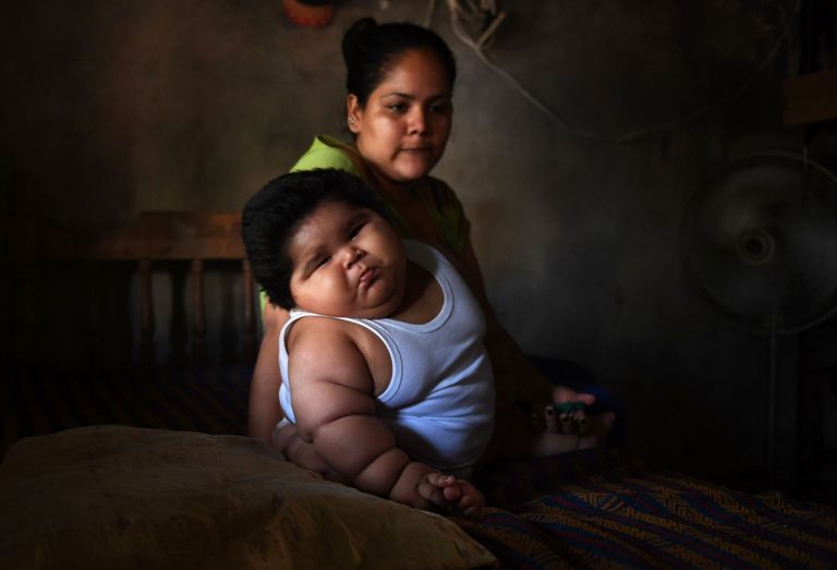 Kümnekuune mehhiko poiss Luis Manuel Gonzales kaalub 28 kilogrammi