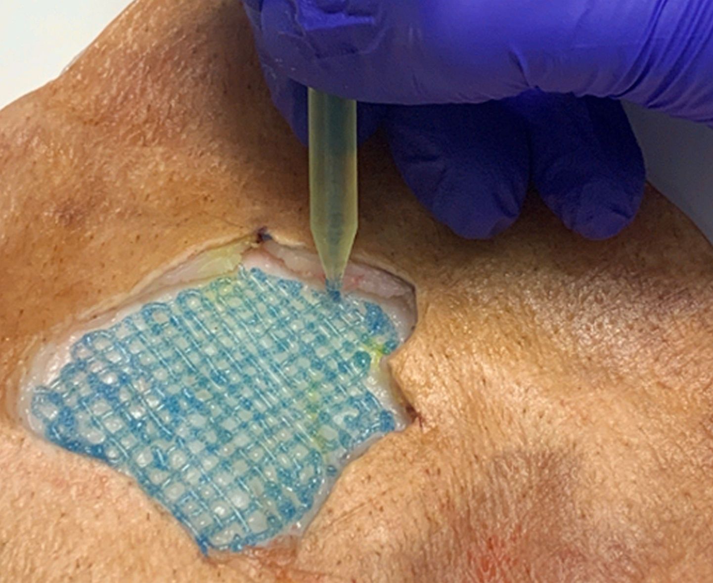 Nõela ja haavaniidi asemel on varsti arstidel käes hoopis pliiatsikujuline bioprinter, millega saab kudesid taastada nii nahal kui inimkeha sisemuses.