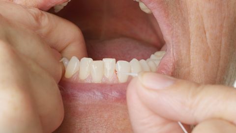 Hambaid niiditades hakkavad igemed veritsema? Ära jäta seda pooleli