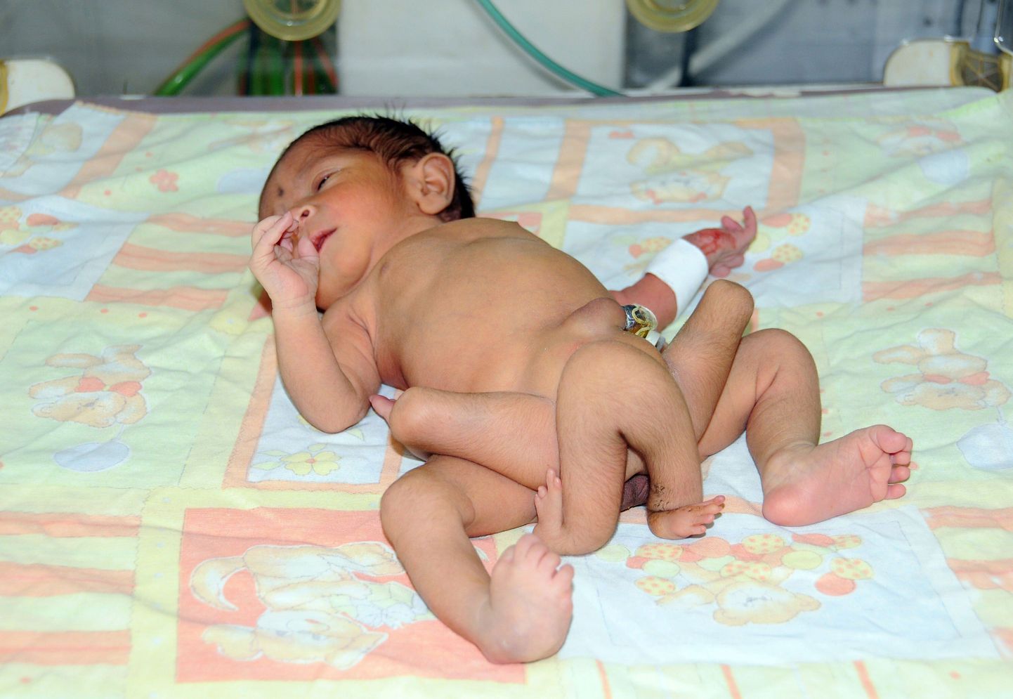 Pakistani kuue jalaga laps