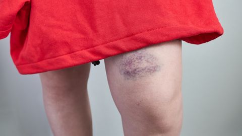 Hemofiiilia: nähtamatu haigus, mis vajab kiiret märkamist